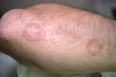 Not All Round Rashes Are Ringworm A Differential Diagnosis Of Hot Sex Picture