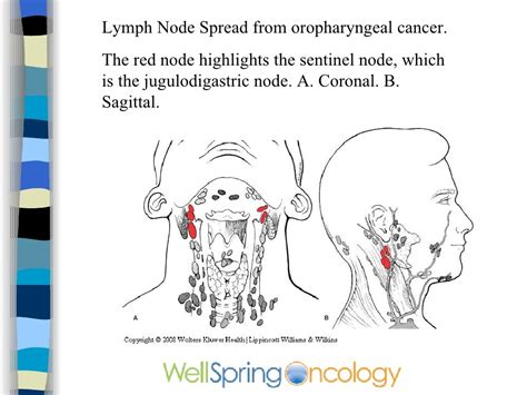Head And Neck Cancer Diagram