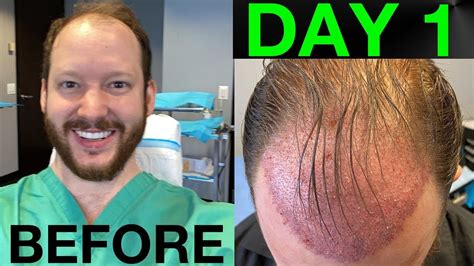 Check Out Our Hair Transplant Patient S YouTube Channel Chronicling His