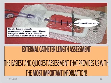 Picc Line External Measurement