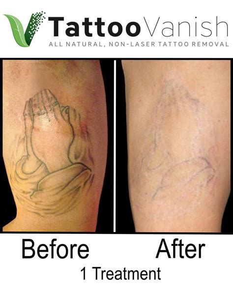 Update 73 Tattoo Laser Removal Before And After Ineteachers