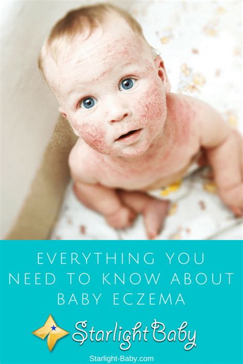 Everything You Need To Know About Baby Eczema Kinacle