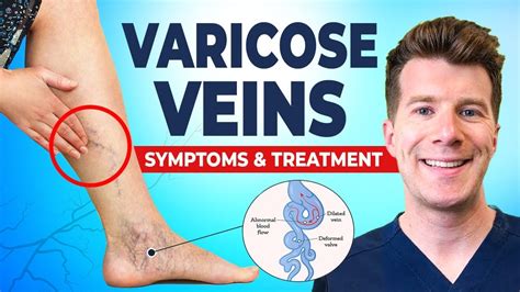 Doctor Explains Varicose Veins Including Thread Veins Causes