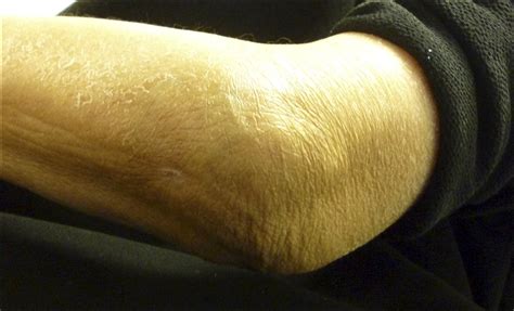 A 61 Year Old Woman With Swelling Of The Left Elbow Jbjs Image Quiz