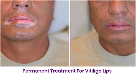 Permanent Treatment For Vitiligo Lips Look Young Clinic