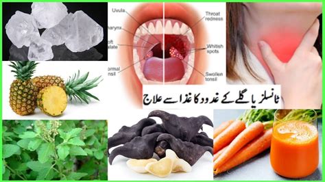 How Remedies For Tonsillitis Home Remedies For Tonsillitis Tonsil