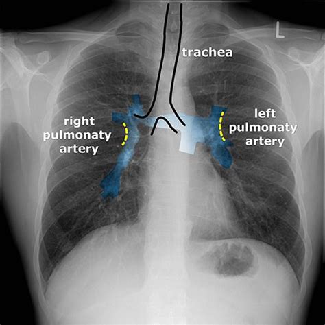 X Thorax Startradiology Medical Radiography Diagnostic Imaging