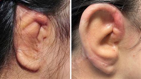Microtia And Complex Congenital Ear Deformities Lifespan