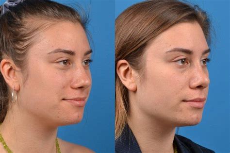 Rhinoplasty Photos Melbourne Fl Patient 30576