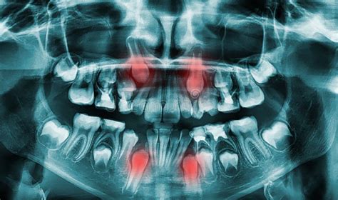 Different Types Of Wisdom Teeth Problems Concept Problem Teeth X Ray