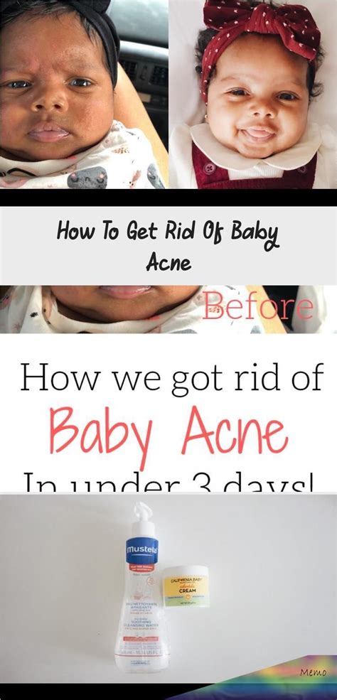 Feb 16 2020 How To Get Rid Of Baby Acne In 2020