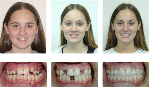 Before And After Braces Gaps Before And After