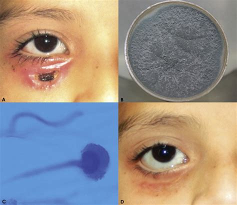 Eyelid Fungal Infections Are Rare And Often Associated With