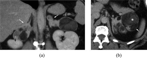 A Coronal And B Axial Contrast Enhanced Ct Of The Adrenals In The