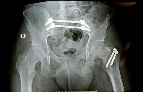 Fracture Of The Greater Trochanter Of Femur And Fracture Pelvis Fixed