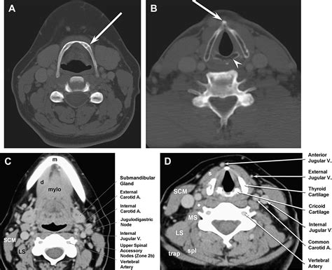 Pertinent Ct Anatomy Of The Neck For Interpreting Petct Pet Clinics