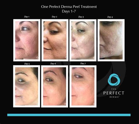 Perfect Derma Peels In Deland Fl A Younger You Med Spa