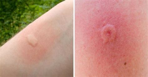 12 Common Bug Bites And How To Recognize Each One Piqure Insecte