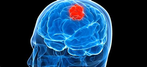 Why Is Glioblastoma So Difficult To Treat