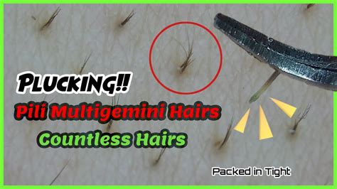 Plucking Pili Multigemini Hairs Countless Hairs 10 Youtube
