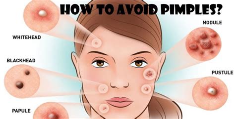 How To Avoid Pimples Causes Symptoms Rid Of Acne Whoopzz