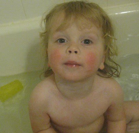 Teh dr doesnt think it is a food allergy. Does this look like a food allergy rash? | BabyCenter