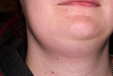 Posterior Cervical Lymph Nodes Swollen Causes Lymph Node Biopsy Call