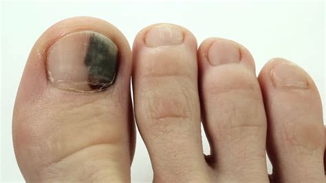 Subungual Hematoma Bruise Under The Nail Of Big Toe Injury To The