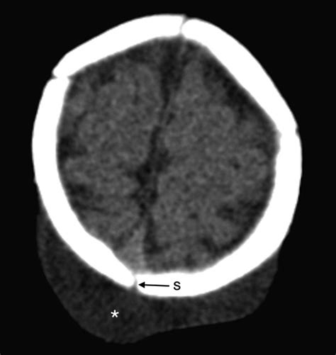 Delayed Infant Subaponeurotic Subgaleal Fluid Collections A Case