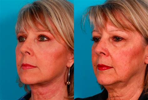 Hilos Tensores Antes Y Despues Hilo Facial Piel