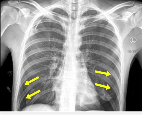 The Chest X Ray Showing Large Bilateral Pneumothoraces Download