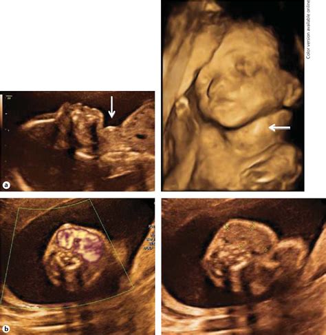Figure 1 From A Rare Case Of Dyshormonogenetic Fetal Goiter Responding