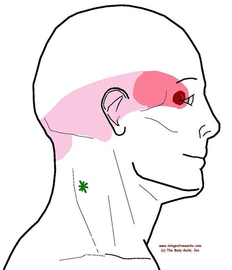 Neck Ache Headache Eye Ache Integrative Works Trigger Points Neck