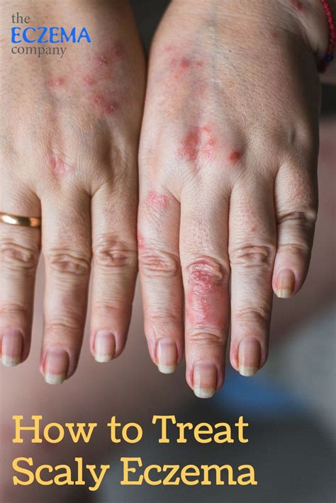 How To Treat Scaly Eczema The Eczema Company Scheduled Via