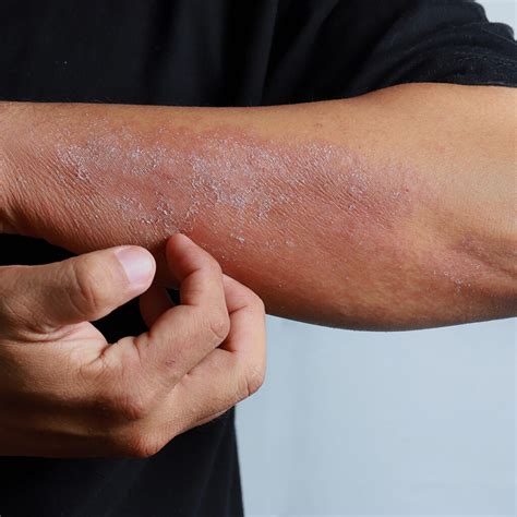 Dermatite At Pica O Que E Seus Sintomas Call Cl Nica E Laborat Rio