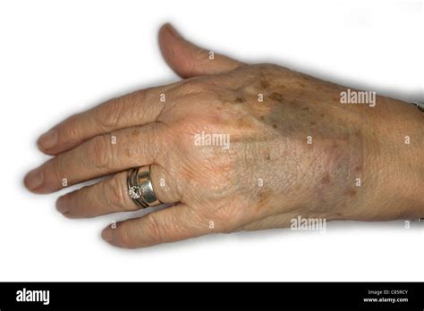 Elderly Woman Bruised Hand Stock Photo Alamy