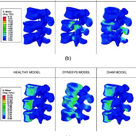 Compression Stress Maps In Discs L3 L4 And L5 S1 For Healthy Dynesys