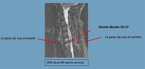 N Vralgie Cervicobrachiale Ilo Rachis Hernie Cervicale Arthord Se