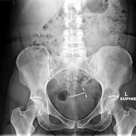 Abdominal Radiograph Shows The Intrauterine Device Projecting Over The
