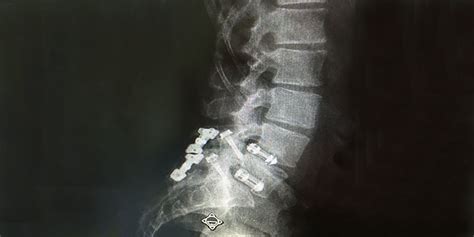 Fractured Spinal Hardware Symptoms And Treatments Bssny