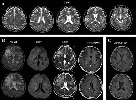 Figure 1 From Development Of Extensive Brain Lesions Following