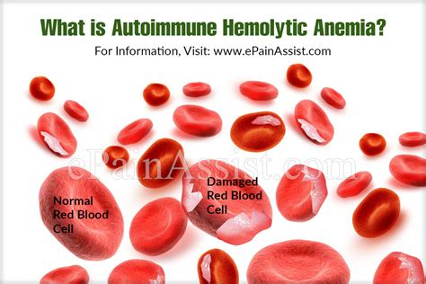 What Is Autoimmune Hemolytic Anemia Causes Symptoms Treatment