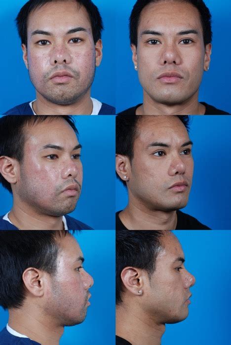 Buccal Cheek Fat Pad Resection Swanson Center For Cosmetic Surgery