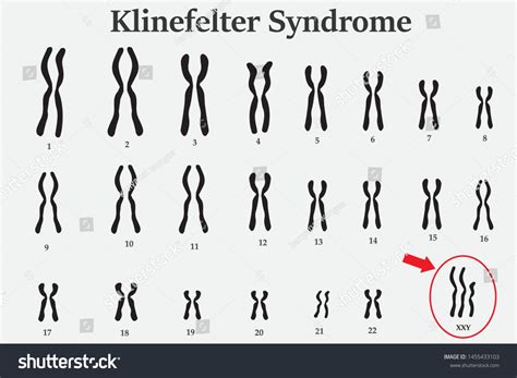 Karyotype Of Klinefelter鈥檚 Or Xxy Usually In Male Is Born With An Extra