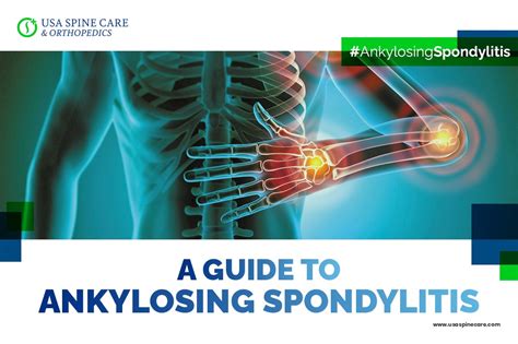 A Guide To Ankylosing Spondylitis Usa Spine Care Laser Spine Surgery