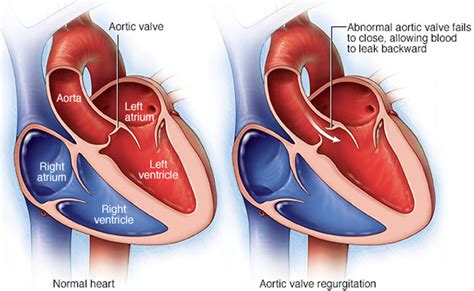 Aortic Valve Regurgitation Causes Symptoms Treatment