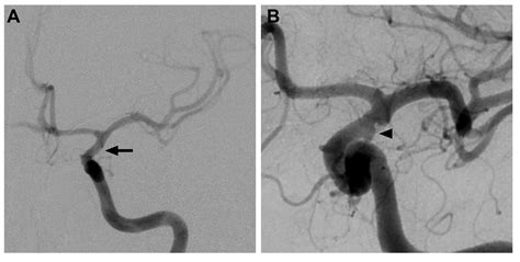 Cureus Long Term Angiographic Findings In Patients Treated With