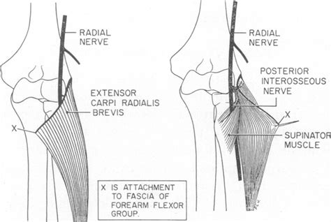 Peripheral Entrapment Neuropathies Of The Upper Extremity Nejm