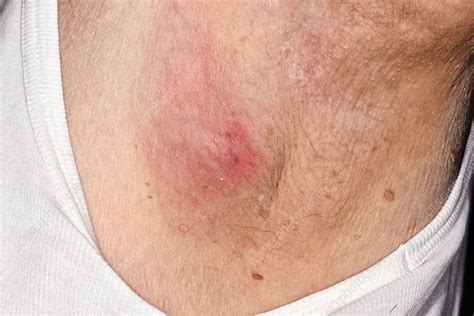 Infected Sebaceous Cyst Stock Image C0269162 Science Photo Library