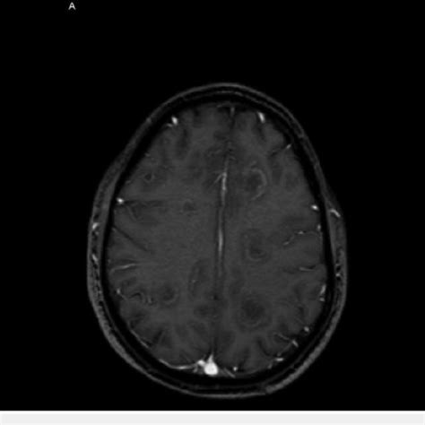 Mri With Contrast Shows Ring Enhancing Multiple Bilateral Lesions